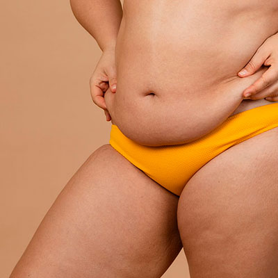 Abdominioplastia