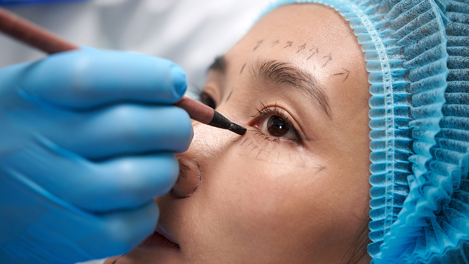 blefaroplastia en quito blefaroplastia en quito