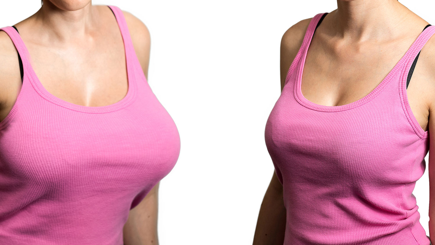 Mamoplastia reductiva Quito - Ecuador lo que necesitas saber Mamoplastia reductiva Quito - Ecuador lo que necesitas saber